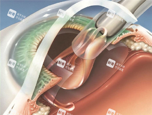 白內(nèi)障手術(shù)細(xì)節(jié)圖
