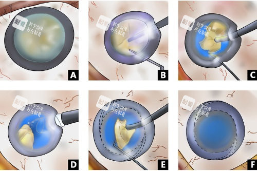超聲乳白內(nèi)障手術(shù)