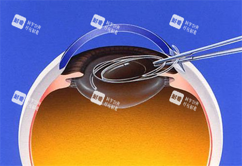 白內障晶體展示圖