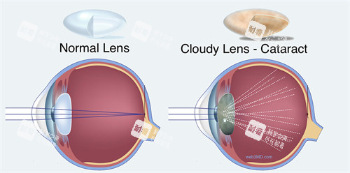 白內(nèi)障圖示