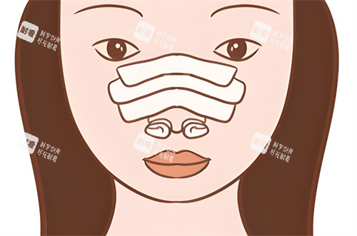 隆鼻修復術(shù)后圖