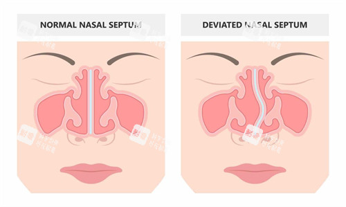 鼻修復手術(shù)前后對比