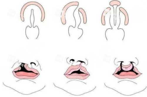 唇裂鼻修復結(jié)構(gòu)圖