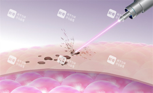 激光祛斑原理圖