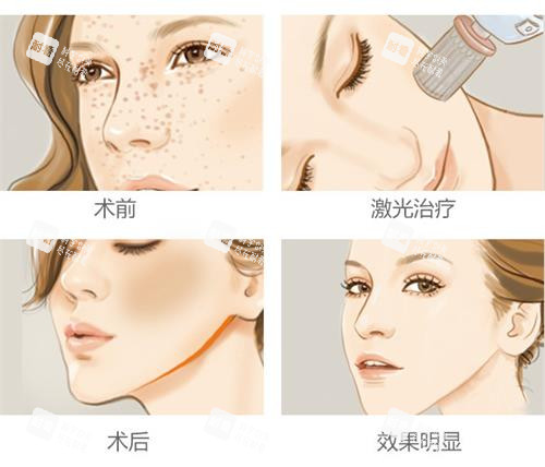 激光祛斑的過程
