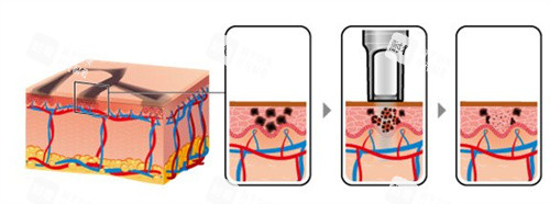 激光祛斑作用原理