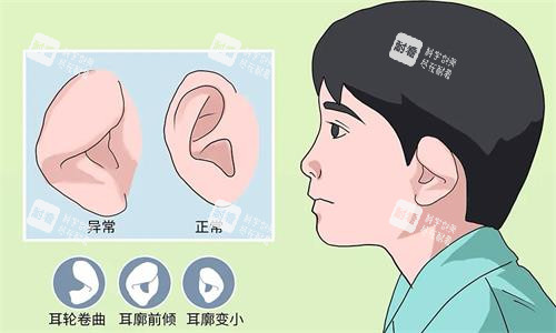 耳朵整形示意圖