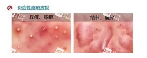 炎癥性痤瘡照片