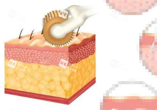 微針作用在皮膚上的動(dòng)畫示意圖