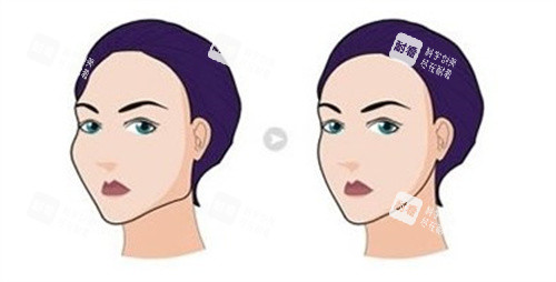 磨骨手術(shù)前后對(duì)比