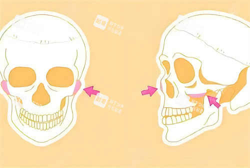 顴骨手術(shù)磨骨部位骨頭演示動(dòng)畫(huà)圖