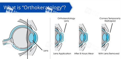 OK鏡改善角膜弧度