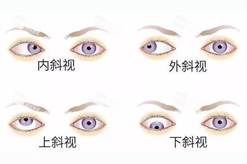 眼睛斜視不同類型分享