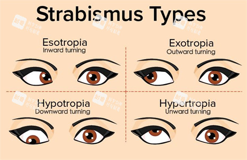 不同情況的眼睛斜視
