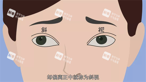 斜視動畫示意圖