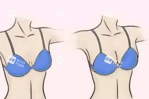 假體豐胸卡通對(duì)比圖