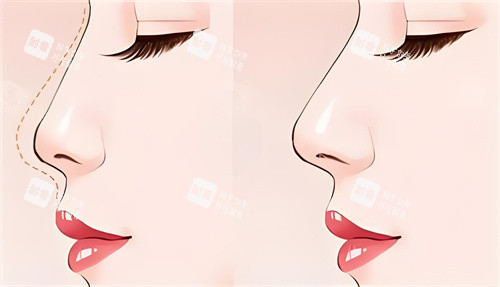 隆鼻前后對比動畫圖