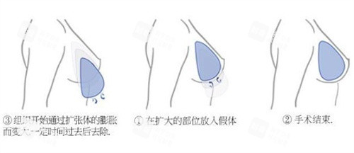 隆胸手術(shù)過程
