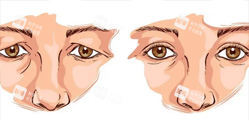 雙眼皮修復(fù)前后