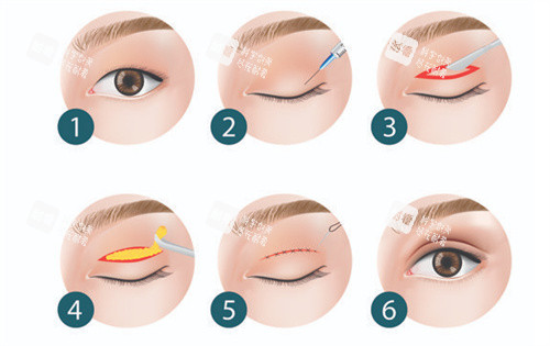 雙眼皮全切手術(shù)過程
