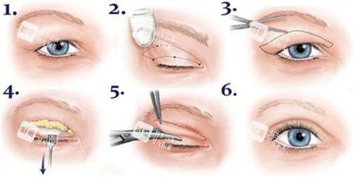 雙眼皮全切術(shù)過程圖