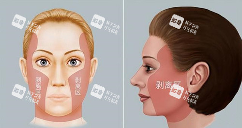 拉皮手術(shù)剝離區(qū) 拉皮手術(shù)剝離區(qū)