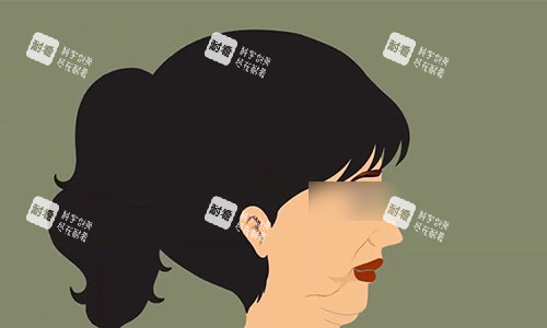 拉皮手術(shù)前的動(dòng)畫示意圖 拉皮手術(shù)前的動(dòng)畫示意圖
