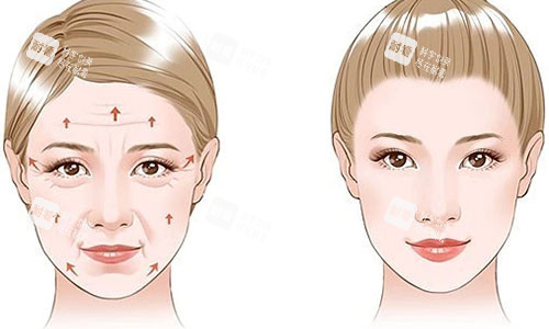 拉皮手術(shù)前后對(duì)比圖 拉皮手術(shù)前后對(duì)比圖