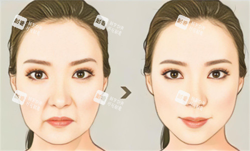 面部抗衰對比 面部抗衰對比