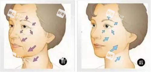 面部抗衰對比圖 面部抗衰對比圖