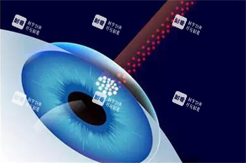 近視眼手術漫畫示意圖