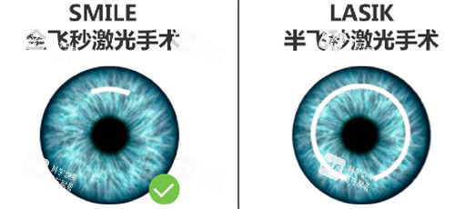 半飛秒和全飛秒手術區(qū)別圖 半飛秒和全飛秒手術區(qū)別圖