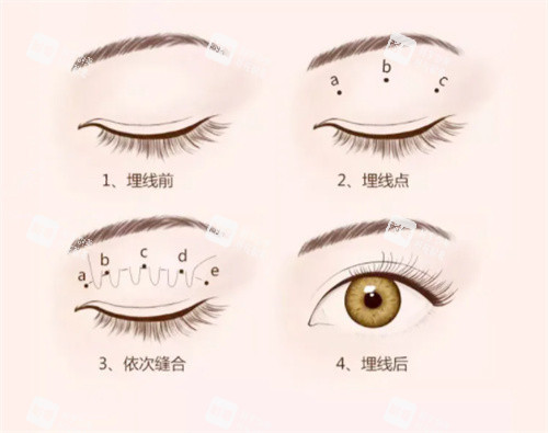 重慶曹陽醫(yī)生修復雙眼皮超可靠！手法精細創(chuàng)傷小，術后結果自然靈動