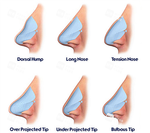 鼻部整形動畫演示圖