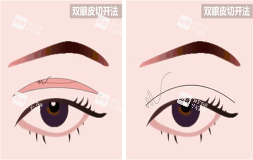 全切雙眼皮手術的切口部位