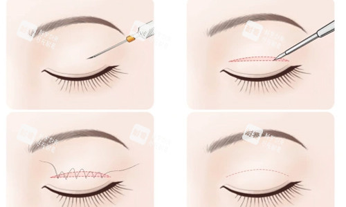 全切雙眼皮簡易術(shù)后流程