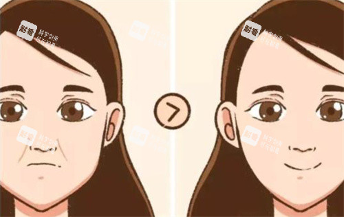 法令紋前后對比