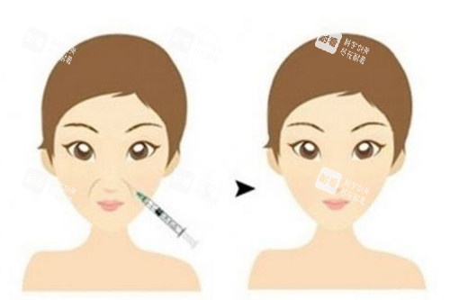 注射填充面部法令紋前后對比卡通示意圖