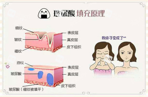 玻尿酸注射填充原理動(dòng)畫演示圖