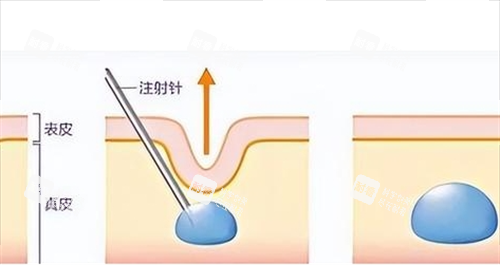 玻尿酸注射皮膚前后對(duì)比