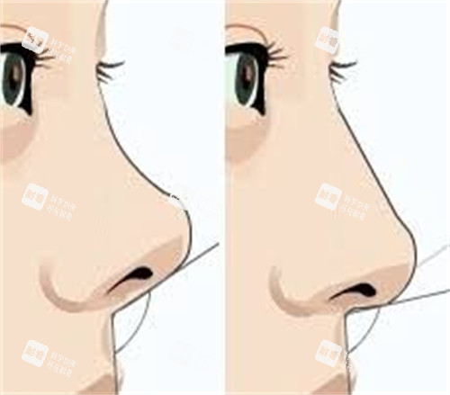 隆鼻手術(shù)膨體隆鼻前后對(duì)比