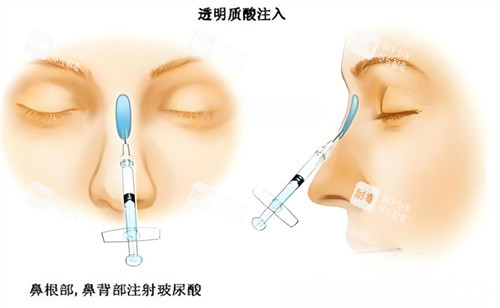 隆鼻玻尿酸注射圖