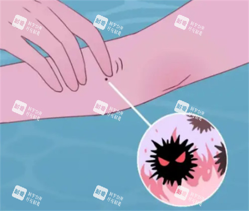 黑色素瘤怎么回事