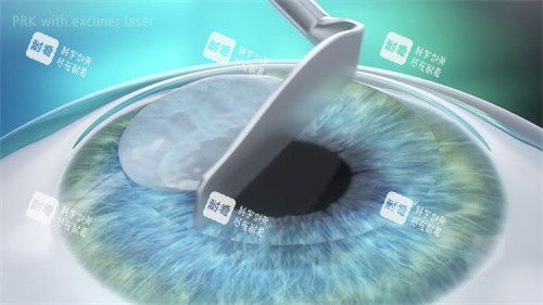 人工晶體植入圖示 展示