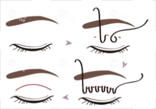 埋線雙眼皮過程圖示