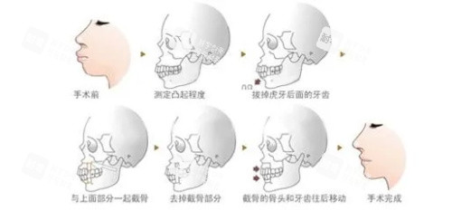 正頜手術(shù)步驟圖示