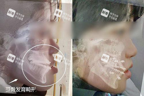 地包天正頜手術(shù)前后對比