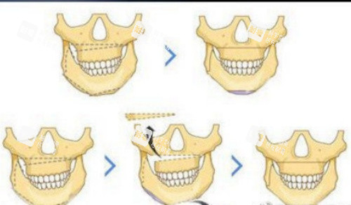 正頜流程示意圖