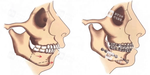 正頜手術(shù)前后圖