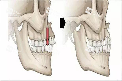 骨性凸嘴正頜示意圖